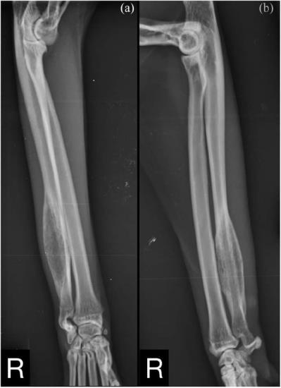 Sterile osteomyelitis in the ulnar diaphysis of a young indoor cat
