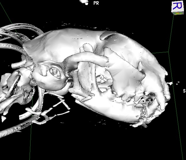 3D reconstruction of CT scan showing fracture of right mandibular ramus.