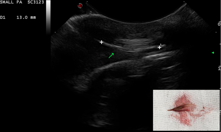 Ultrasound of Dog with Grass Seed Abscess