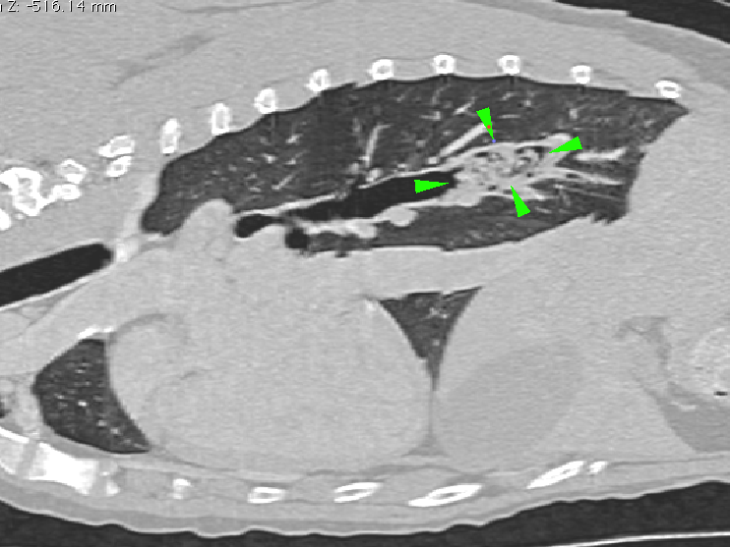 CT sagittal view of the chest