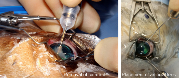Cataract surgery during and post cataract removal