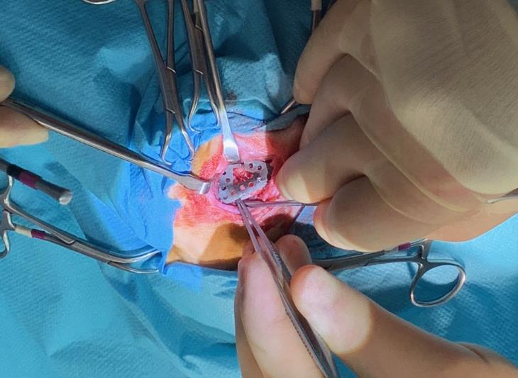Surgical approach to 3D implant 