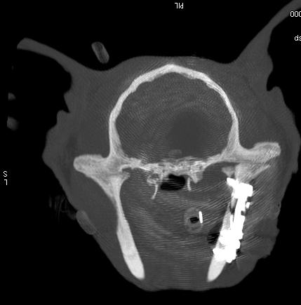 Axial image from a post-operative CT scan showing reduction of the fracture