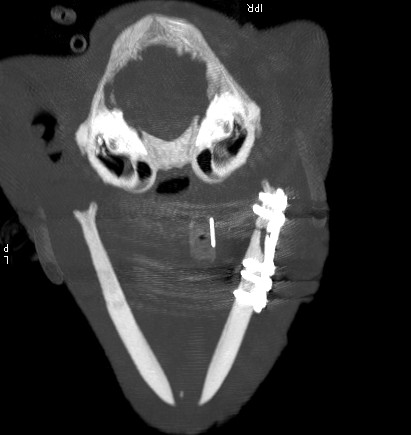 Axial image from a post-operative CT scan showing reduction of the fracture