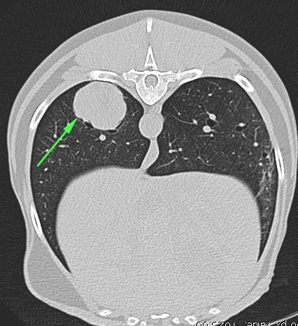 CT transverse view of chest