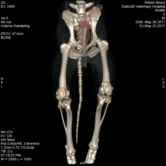 Combined distal femoral varus staged correction