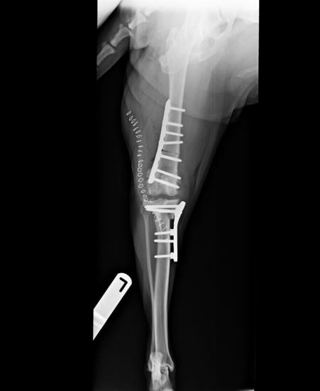 Combined distal femoral varus staged correction