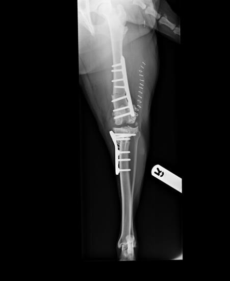 Combined distal femoral varus staged correction