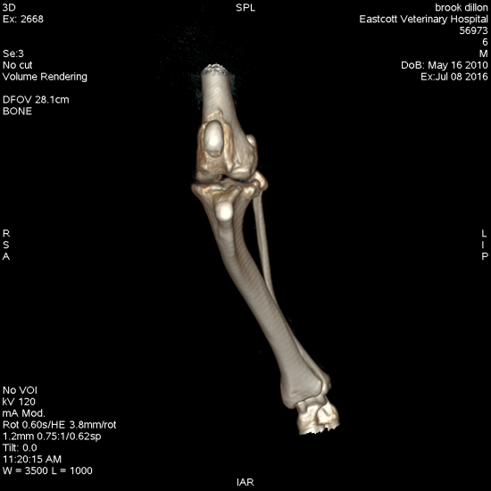 Combined excessive tibial plateal treatment