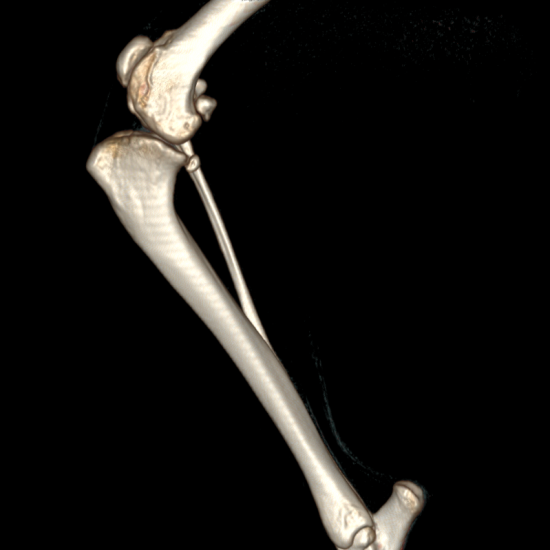 Combined excessive tibial plateal treatment