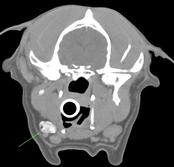 coronal CT showing local extent of tumour