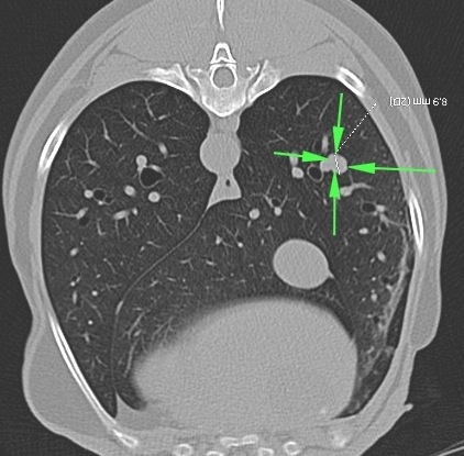 Transverse Coronal CT Reconstructions 