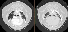 Chest CT scan